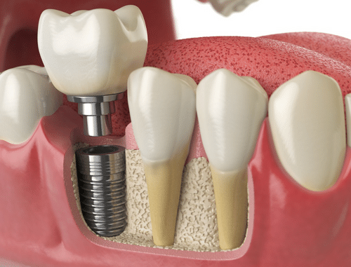 Tratamento com implantes dentários
