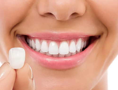 Tratamento de lentes de contato dental